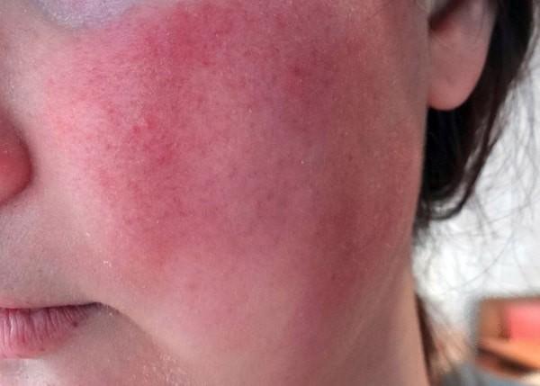 Da mặt bị cháy nắng đỏ rát: 5 cách xử lý hiệu quả dành cho bạn